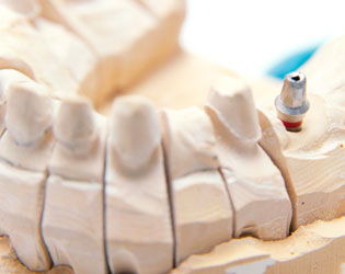 Can Dental Implants Get Cavities?