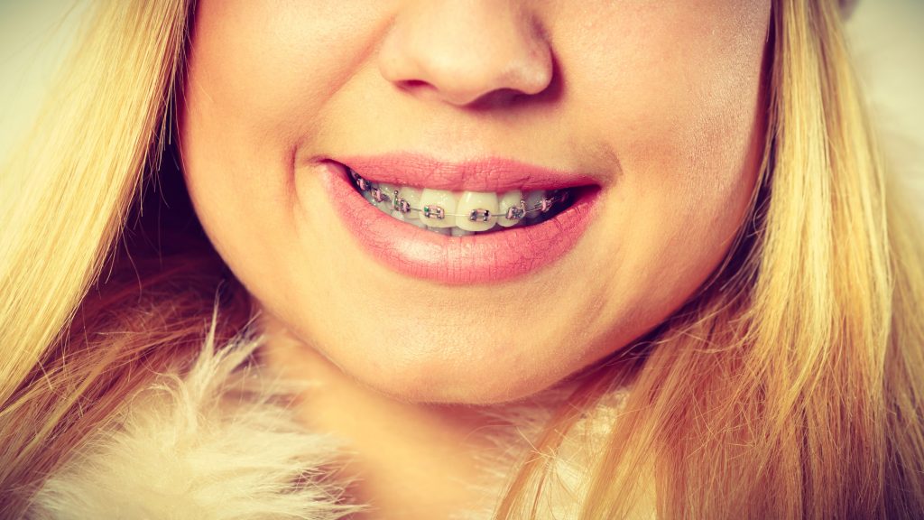 Smiling Girl with Braces